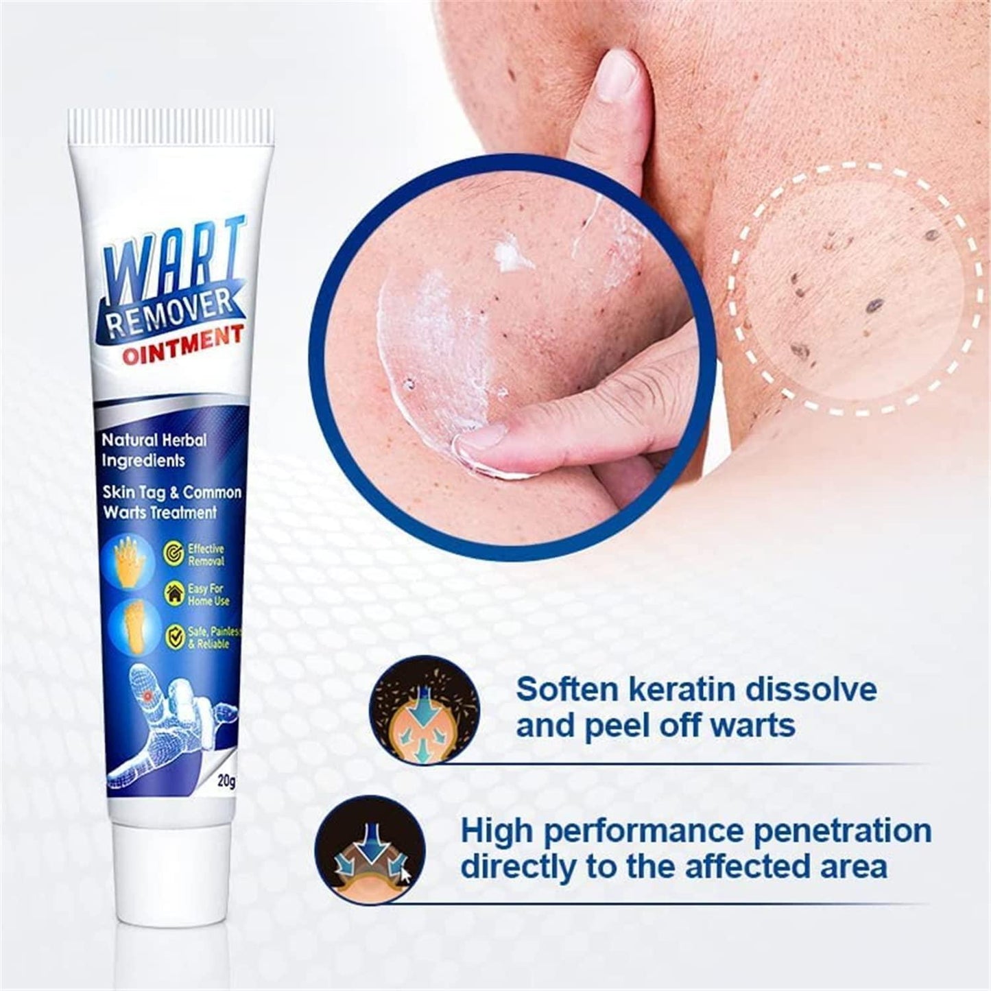 Skin Warts Removal Cream- Buy 1 Get 1 Free