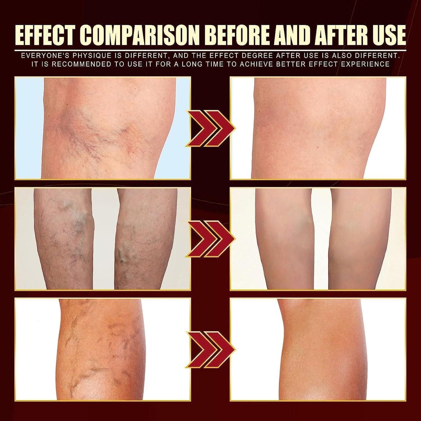 Vein Healing Varicose Veins Treatment Spray Pack of 2