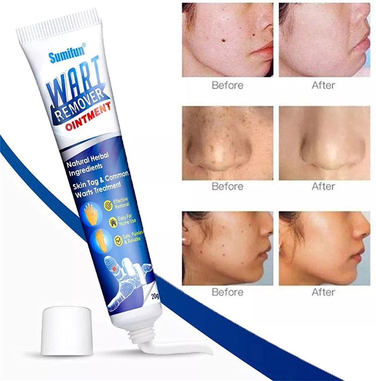 Skin Warts Removal Cream- Buy 1 Get 1 Free